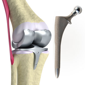 Biomedical - Castings Densification